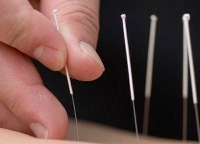 Acupuncture thumbnail